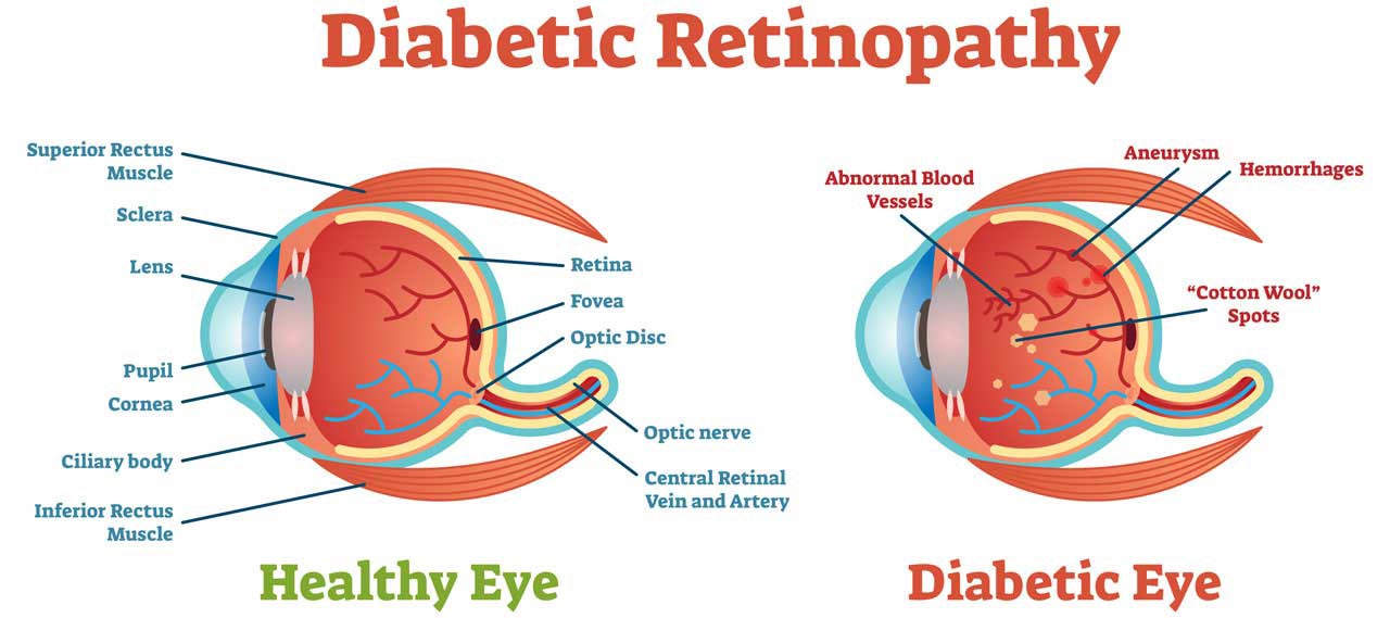 Research suggests that astragalus may help prevent damage to eyes caused by high blood sugar from diabetes.