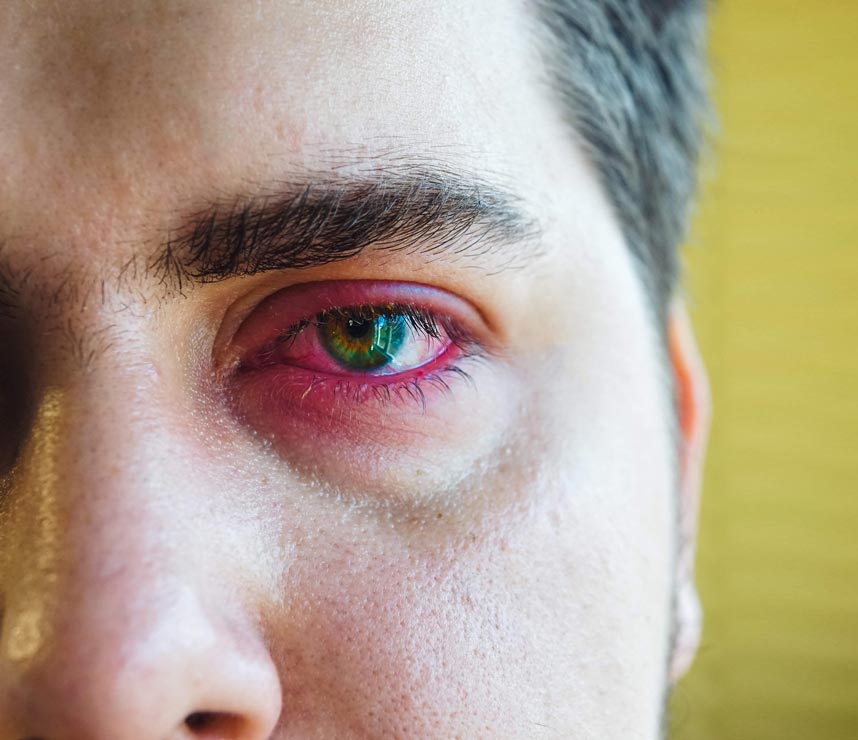 Astragalus for Herpes Eye Infections Astragalus may help suppress inflammatory proteins produced by herpes simplex keratitis.