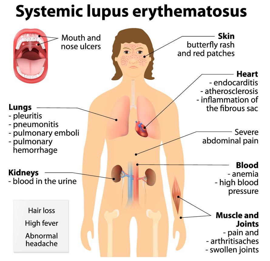 Symptoms of Lupus Erythematosus Astragalus may help reduce symptoms and complications of lupus, including nephritis.